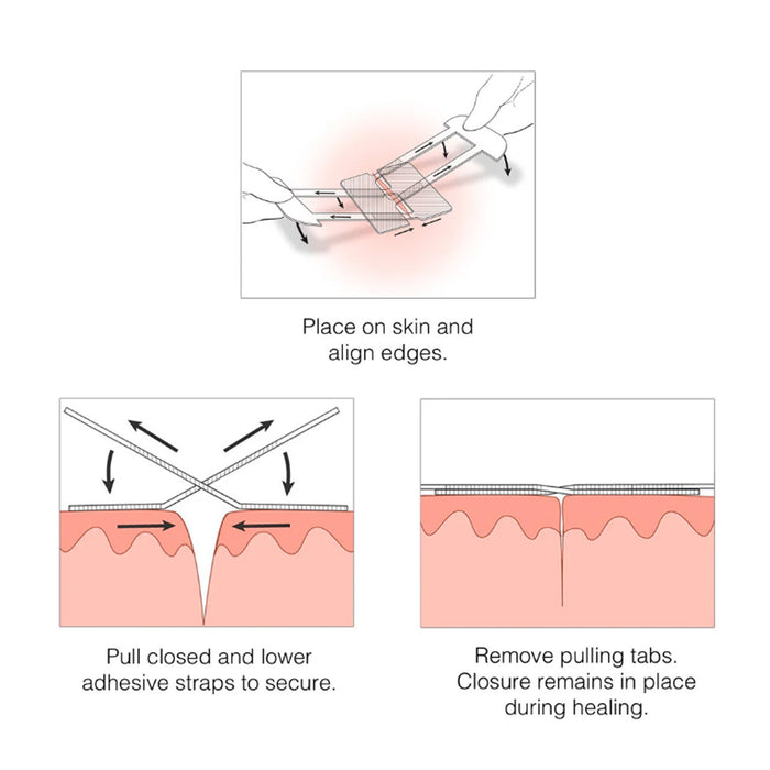 Emergency Laceration Closures