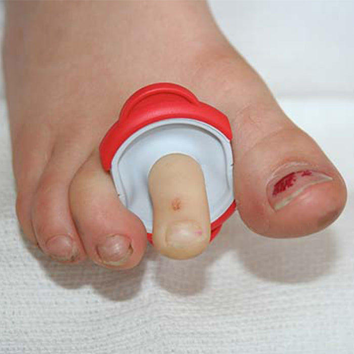 T-Ring Flex Finger Tourniquet